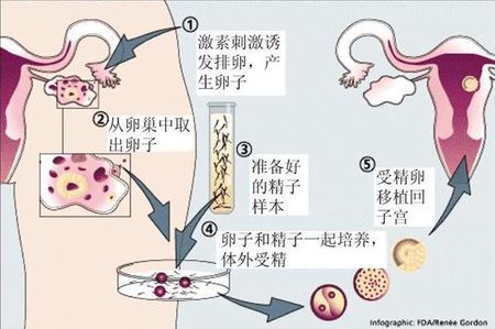 关于供精试管供卵中介